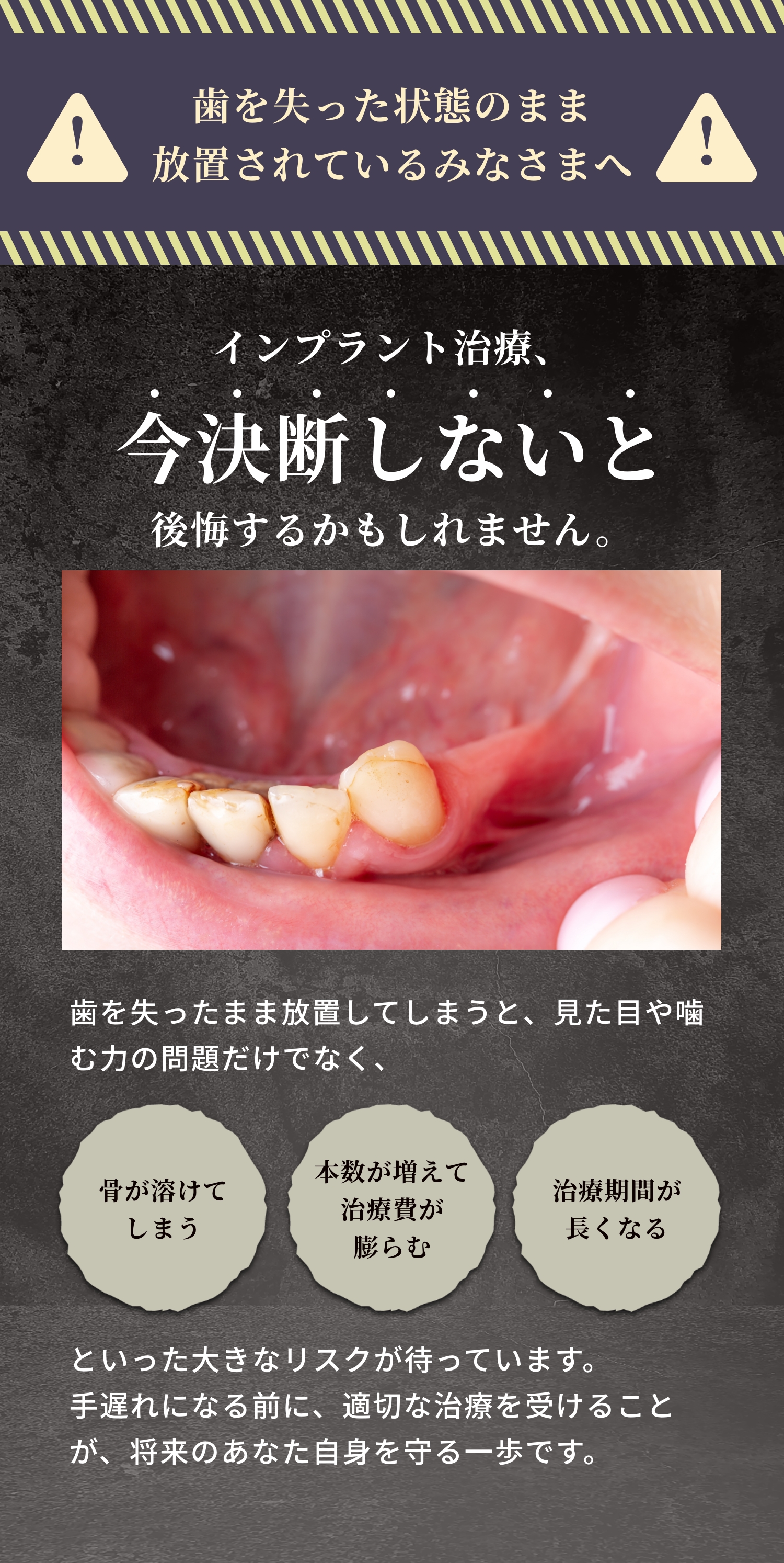 歯を失った状態のまま放置されているみなさまへ