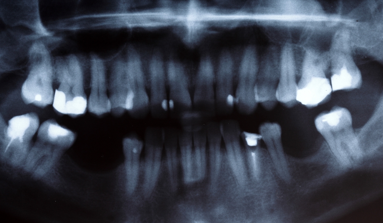 放置すると「骨」が溶ける