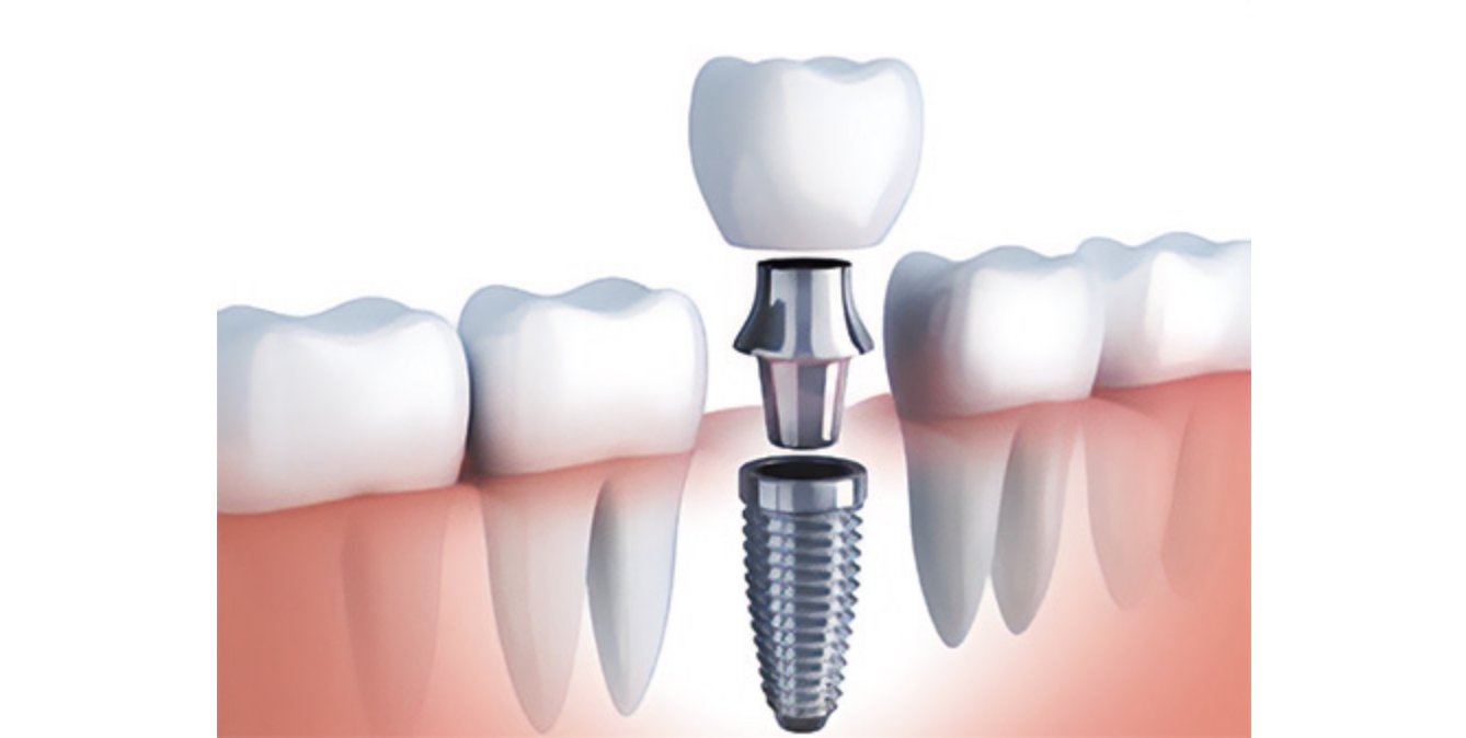 「AQB インプラント」とは？